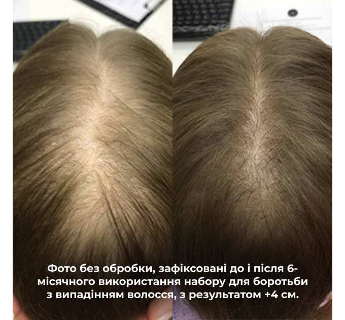 Шампунь + Cироватка проти випадіння волосся Hillary Serenoa &amp; РР Hair Loss Control