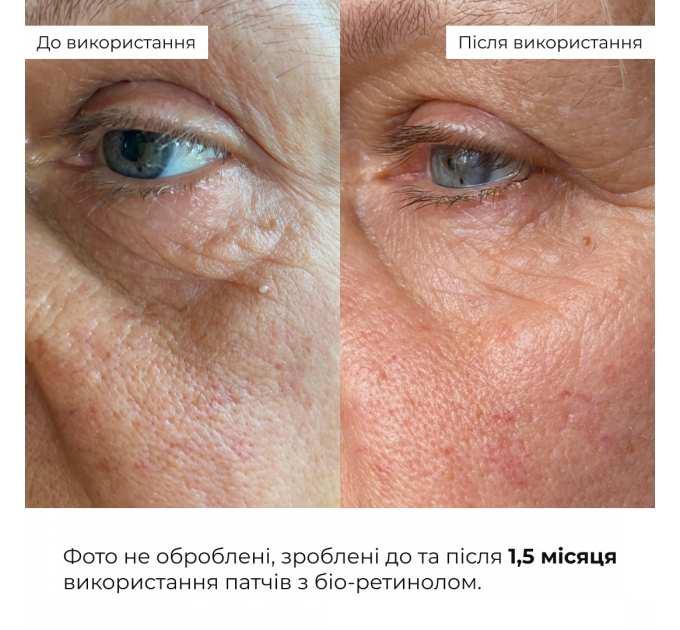 Розгладжувальні патчі з біо-ретинолом Hillary Bacuchiol Wrinkle Correcting & Eye Lift Patches, 60 шт