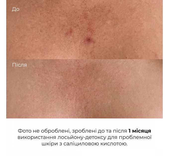 Лосьйон-детокс для проблемної шкіри з саліциловою кислотою Hillary Anti-Acne Salicylic Body Lotion, 150 мл