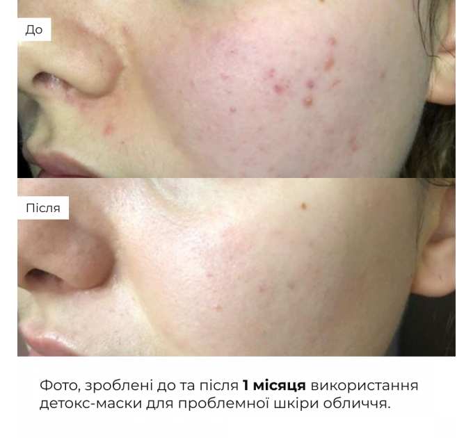 Глиняна детокс-маска для проблемної шкіри обличчя Hillary Anti-Acne & Detox Clay Mask, 90 мл