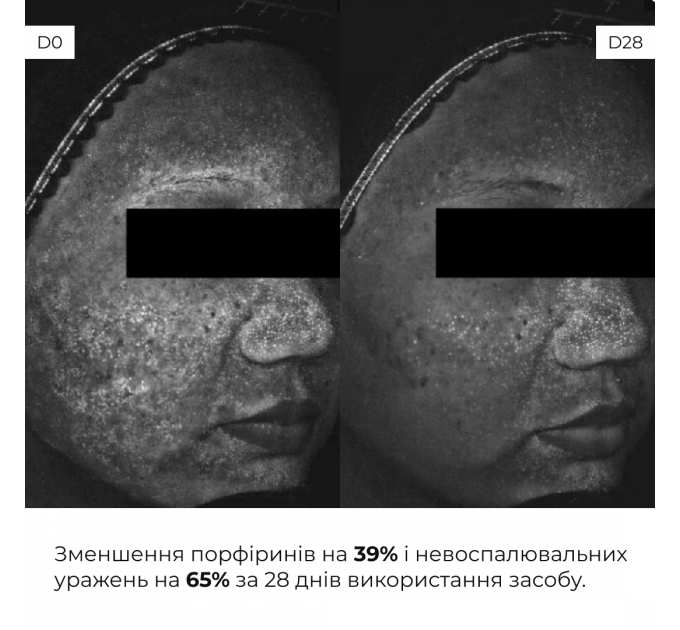 Весняний догляд для жирного типу шкіри