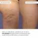 Набір антицелюлітних охолоджувальних обгортань Hillary Cooling Anti-Cellulite Wrap Set