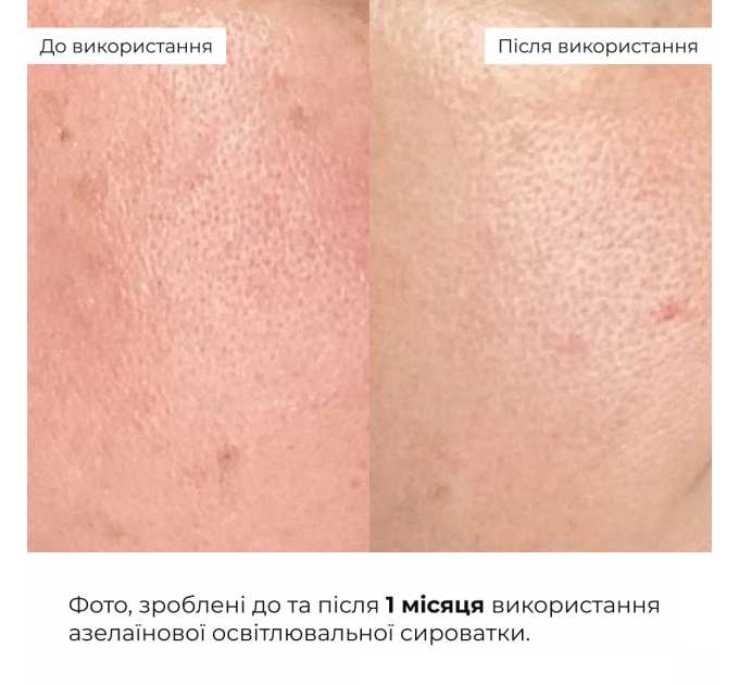 Набір для освітлення та захисту шкіри з вітаміном С і азелаїновою кислотою Hillary Azelaic & Vitamin C Brightening & SPF Protection Set
