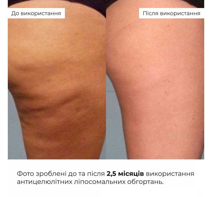 Набір антицелюлітних охолоджувальних обгортань Hillary Cooling Anti-Cellulite Wrap Set