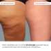 Набір антицелюлітних охолоджувальних обгортань Hillary Cooling Anti-Cellulite Wrap Set