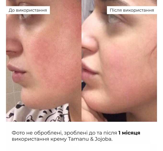 Набір себорегулюючого догляду для жирної та проблемної шкіри обличчя Hillary for oily and problematic skin