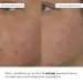 Набір відновлення після запалень та постакне Hillary Recovery Set for Post-Inflammation & Post-Acne