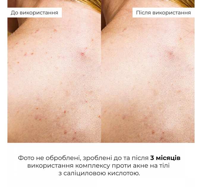 Сироватка для проблемної шкіри з саліциловою кислотою Hillary Back & Body Acne Control Serum, 50 мл