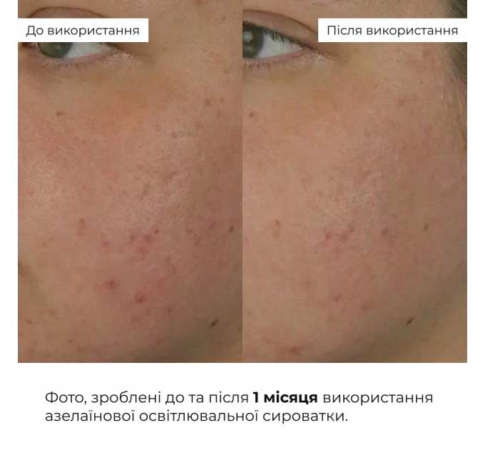 Азелаїнова освітлювальна сироватка Hillary Azelight Defense Serum, 30 мл