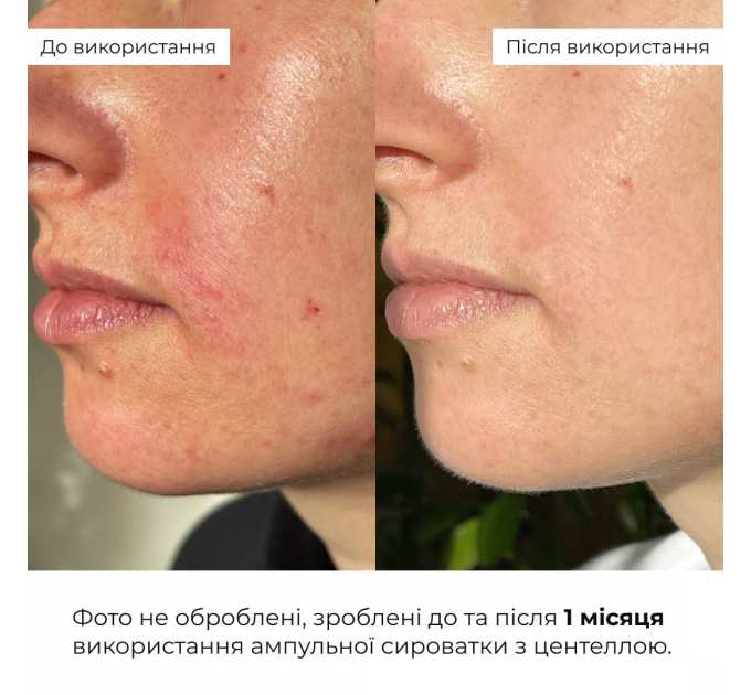 Ампульна сироватка з центеллою Hillary Ampoule Centella Serum, 30 мл