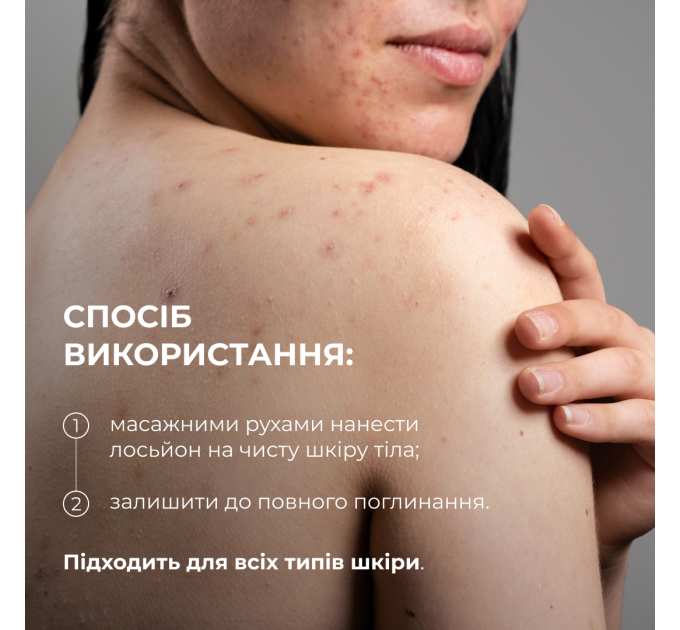 Лосьйон-детокс для проблемної шкіри з саліциловою кислотою Hillary Anti-Acne Salicylic Body Lotion, 150 мл