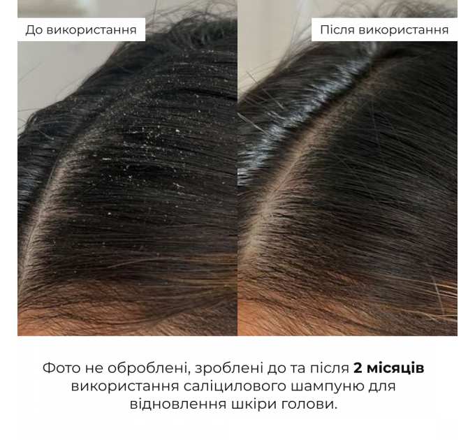 Комплекс для глибокого очищення та відновлення волосся і шкіри голови з термозахистом Hillary Deep Cleanse & Hair Restoration Set with Heat Protection