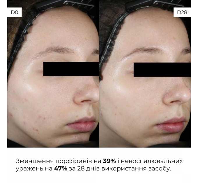 Весняний догляд для жирного типу шкіри
