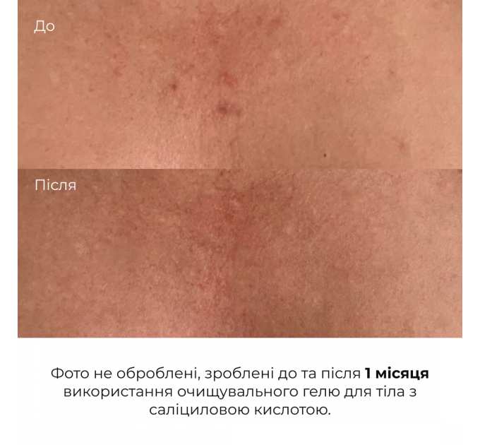 Очищувальний гель для тіла з саліциловою кислотою Hillary Anti-Acne Salicylic Body Wash, 200 мл