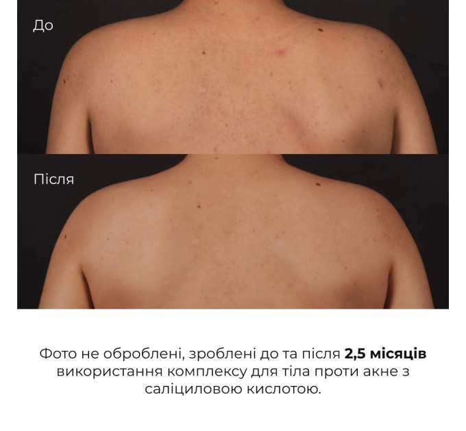 Комплекс для тіла проти висипань і сонячного пошкодження SPF 50+ Hillary Body Care Set for Acne-Prone Skin & Sun Protection