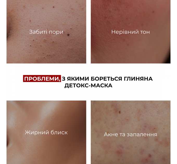 Глиняна детокс-маска для проблемної шкіри обличчя Hillary Anti-Acne & Detox Clay Mask, 90 мл