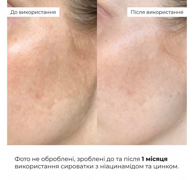 Мультисироватка з ніацинамідом та цинком Hillary Multi Niacinamid serum, 30 мл